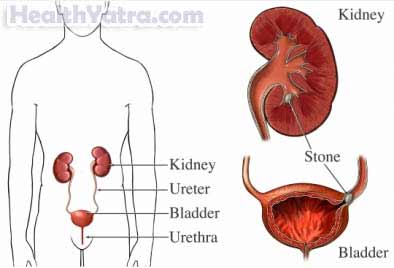 Acute Interstitial Nephritis, Causes, Symptoms, and Cost Surgery Treatment in India Acute Interstitial Nephritis