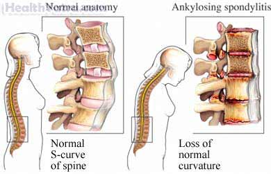 Ankylosing Spondylitis