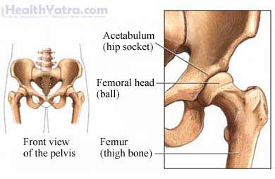 Aseptic Necrosis of the Hip