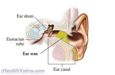 Cerumen Impaction Definition, Causes, Symptoms and Cost Treatment in India - Update 2023 Cerumen Impaction