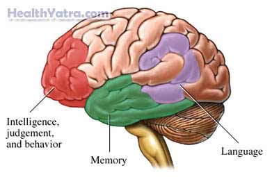 Dementia Definition, Causes, Symptoms, Complications and Cost Surgery Treatment Hospital in India Dementia