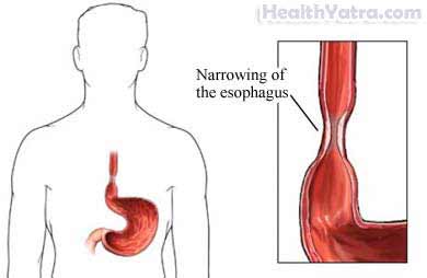 Esophageal Stricture