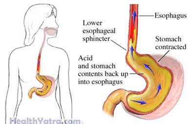 Gastroesophageal Reflux Disease Adolescent Gastroesophageal Reflux Disease Adolescent