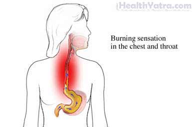 Heartburn Overview