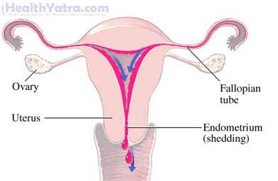 Heavy Menstrual Bleeding