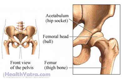 Hip Dislocation Hip Dislocation