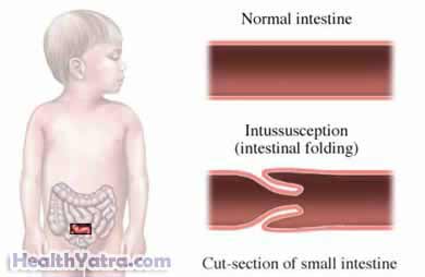 Intussusception Intussusception