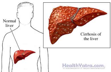 Liver Cancer