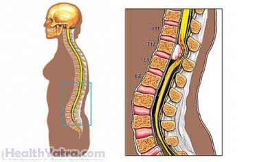 Meningioma Meningioma