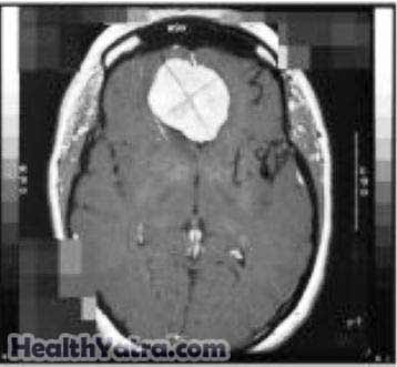 Meningioma Meningioma1
