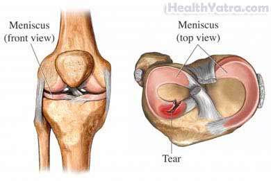 Meniscal Tear