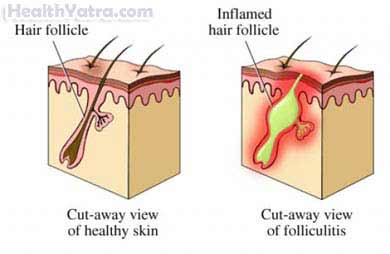 Methicillin Resistant Staph Infection