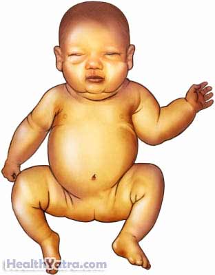 Newborn Jaundice