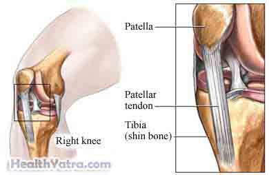 Osgood Schlatter Disease