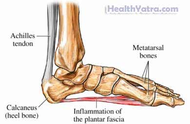 Plantar Fasciitis