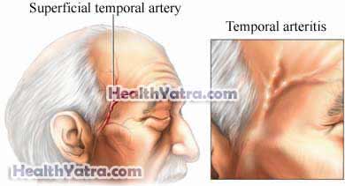 Polymyalgia Rheumatica