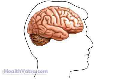 Postconcussion Syndrome