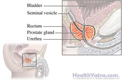 Prostatitis