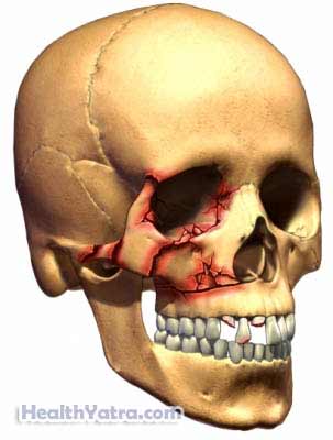 Skull and Facial Fracture