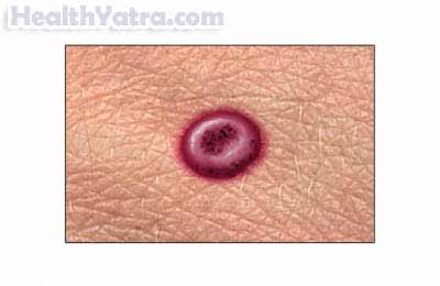 Molluscum Contagiosum Molluscum Contagiosum