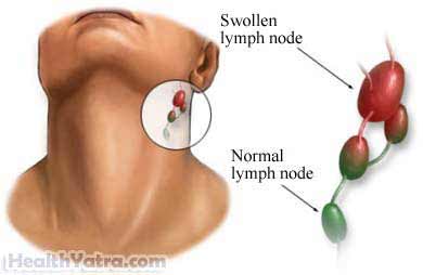 Mononucleosis