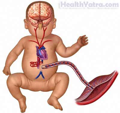 Neonatal Drug Withdrawal