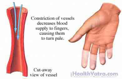 Raynauds Disease and Phenomenon