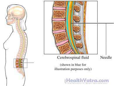 Reye's Syndrome Reyes Syndrome