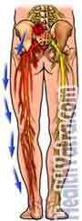 Sciatica