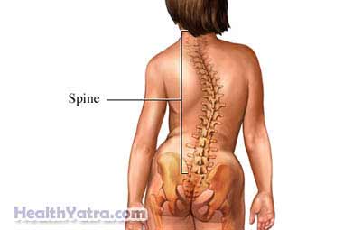 Scoliosis