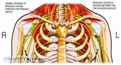 Thoracic Outlet Syndrome Thoracic Outlet Syndrome