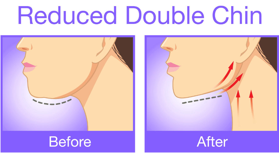 Low Cost Chin Implant in India or Chin Augmentation Cosmetic Surgery in India General Shape of Chin Implants