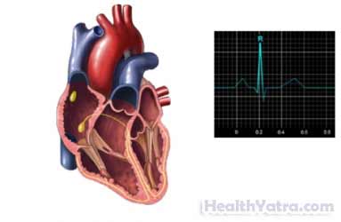 Ambulatory Cardiac Monitoring