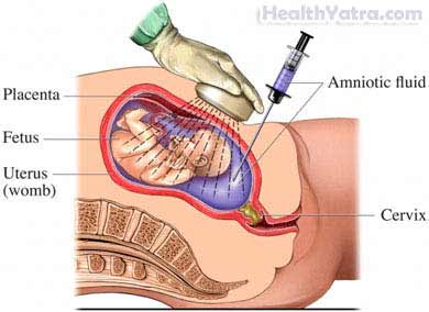 Amniocentesis 1