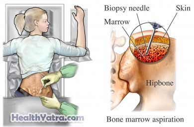 Bone Marrow Biopsy 1
