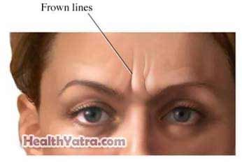 Botulinum Toxin Injections Cosmetic 2