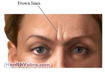 Botulinum Toxin Injections Cosmetic