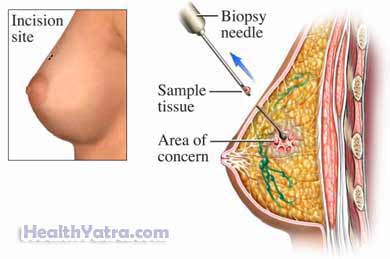 Breast Needle Biopsy 2