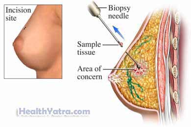Breast Needle Biopsy 3