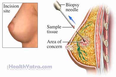 Breast Needle Biopsy
