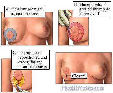 स्तन न्यूनीकरण