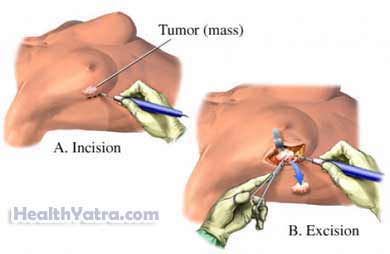 Breast Surgical Biopsy 1