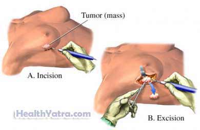 Breast Surgical Biopsy 3