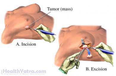 Breast Surgical Biopsy 4