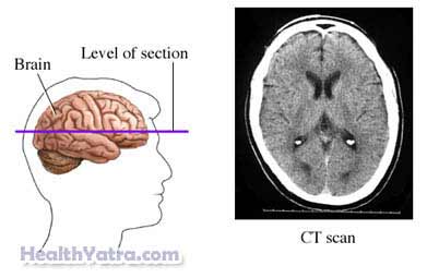 CT Scan of the Head 1