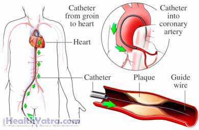 Cardiac Catheterization 1