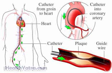Cardiac CatheterizationCoronary arteriography