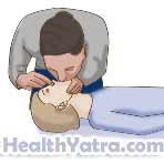 Cardiopulmonary Resuscitation for Children Age 1 to Early Teens 1
