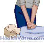 Cardiopulmonary Resuscitation for Children Age 1 to Early Teens 2