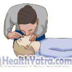 Cardiopulmonary Resuscitation for Children Age 1 to Early Teens 3